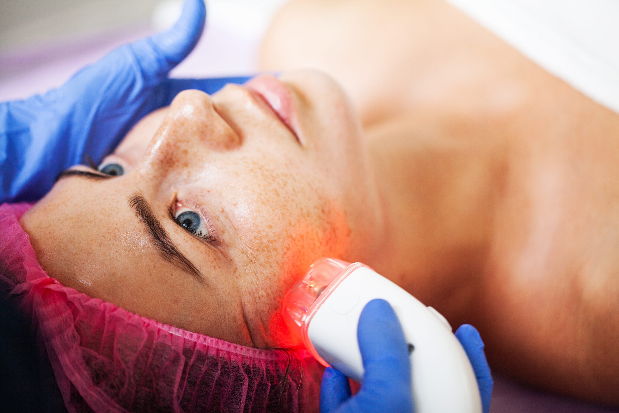 Treating Acne Scars with Laser Therapy: Your Ultimate Solution