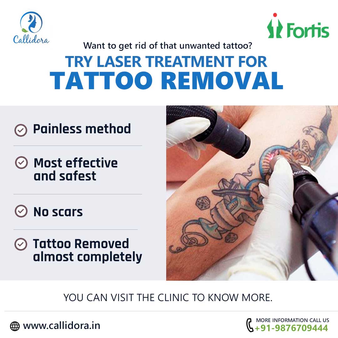 Does Laser Tattoo Removal Hurt? - NAAMA Studios