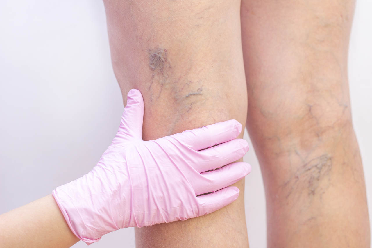 Can I leave Varicose veins untreated?