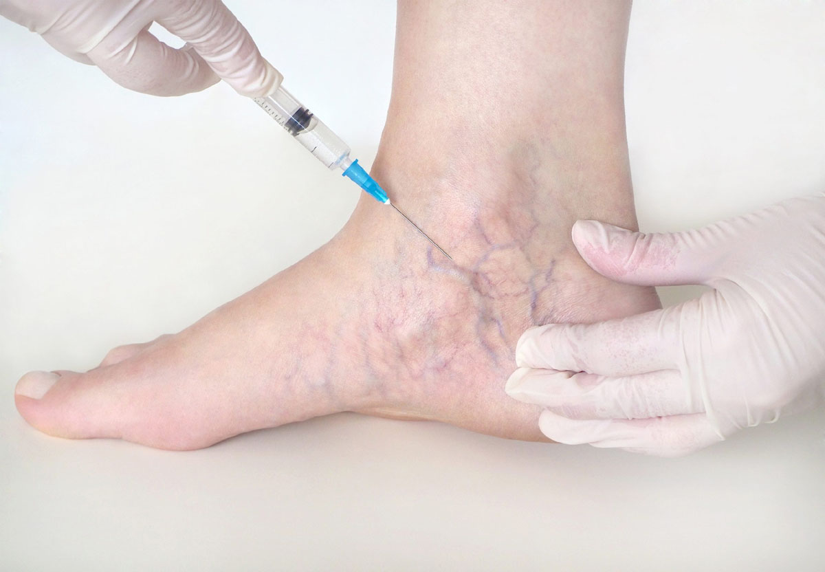 Say Goodbye to Spider Veins with Sclerotherapy for Enhanced Vascular Health