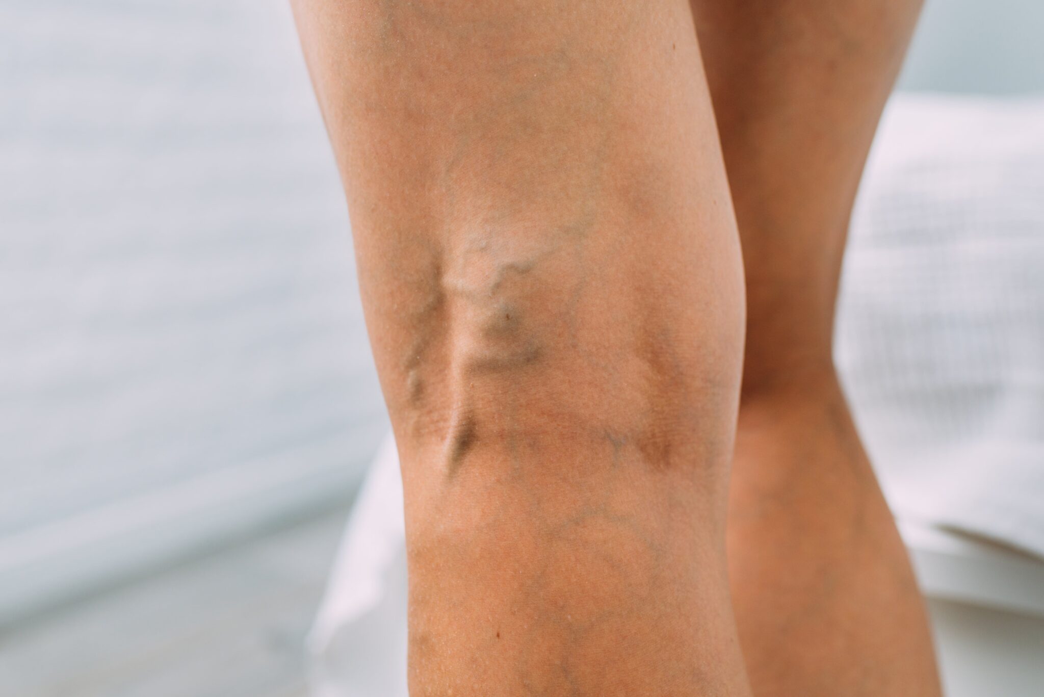 When to Seek Medical Treatment for Varicose Veins