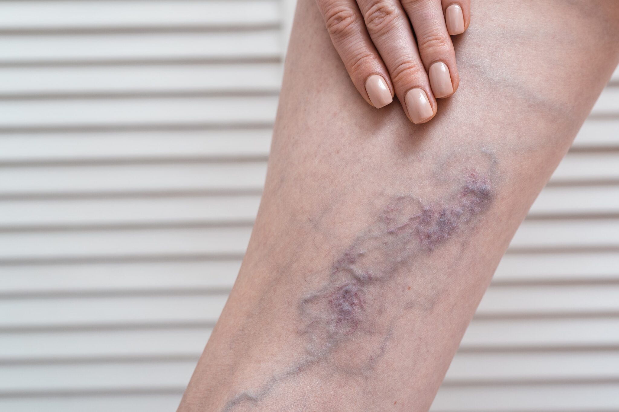 Deep Vein Thrombosis (DVT): What Puts You at Risk?