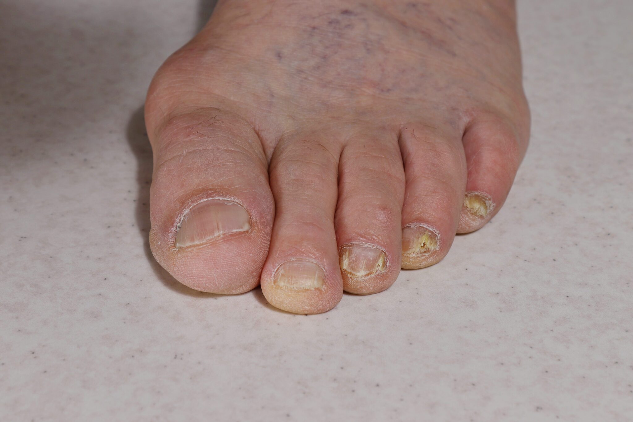 Understanding Nail Fungal Infections: Causes and Early Signs